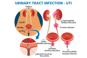 home remedy for uti

